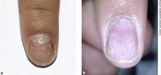 孩子指甲軟薄易斷、月牙少、長白點、豎紋是顯示身體有健康風(fēng)險嗎？(圖7)