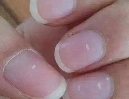 孩子指甲軟薄易斷、月牙少、長白點、豎紋是顯示身體有健康風(fēng)險嗎？(圖6)