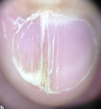 孩子指甲軟薄易斷、月牙少、長白點、豎紋是顯示身體有健康風(fēng)險嗎？(圖11)