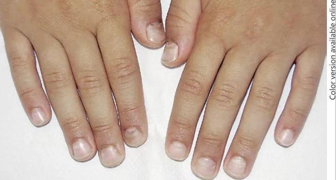 孩子指甲軟薄易斷、月牙少、長白點、豎紋是顯示身體有健康風(fēng)險嗎？(圖10)