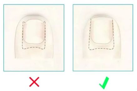 孩子指甲軟薄易斷、月牙少、長白點、豎紋是顯示身體有健康風(fēng)險嗎？(圖13)